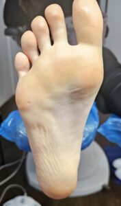stopa po wykonanym pedicure podologicznym