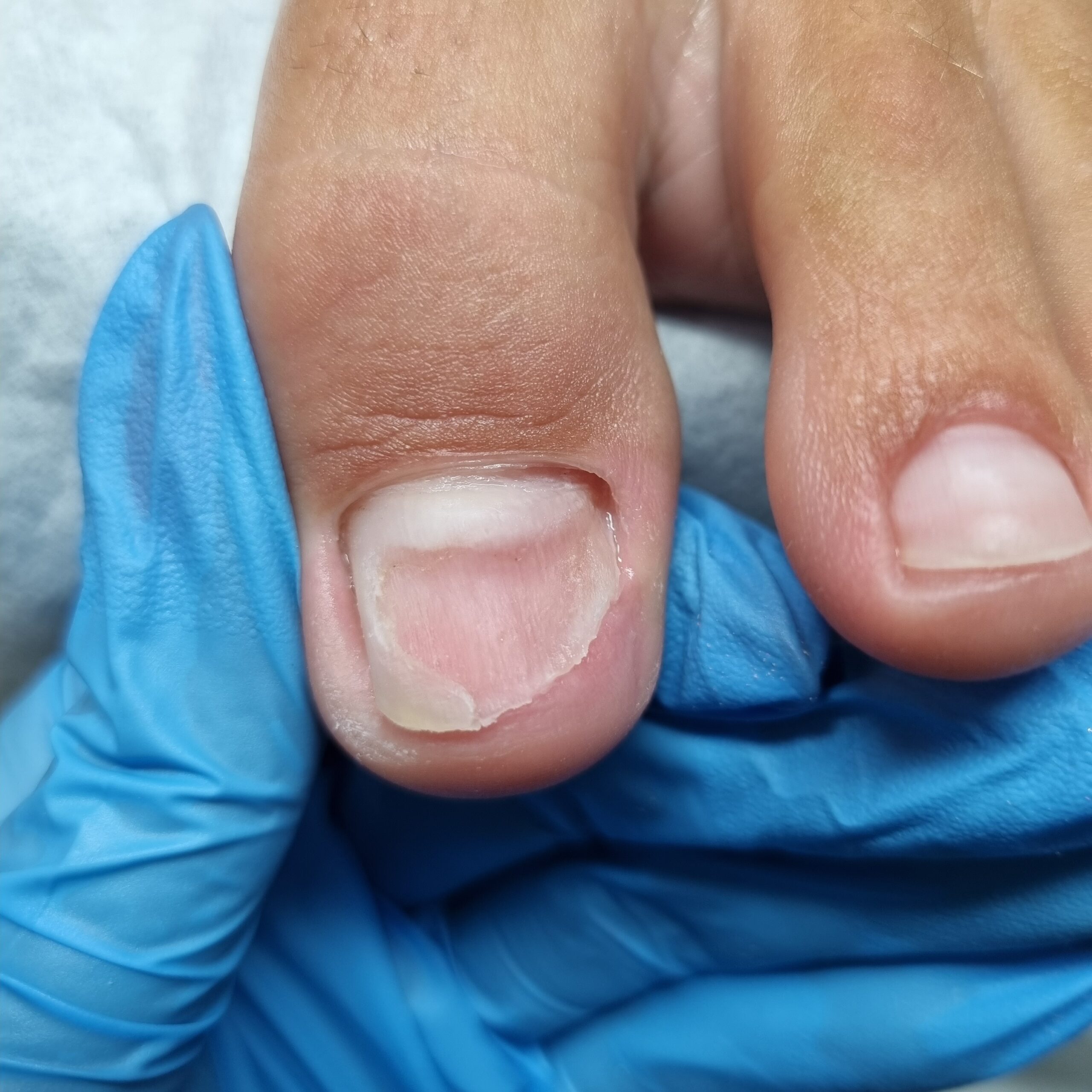 paznokieć po usunięciu onycholizy bez rekonstrukcji