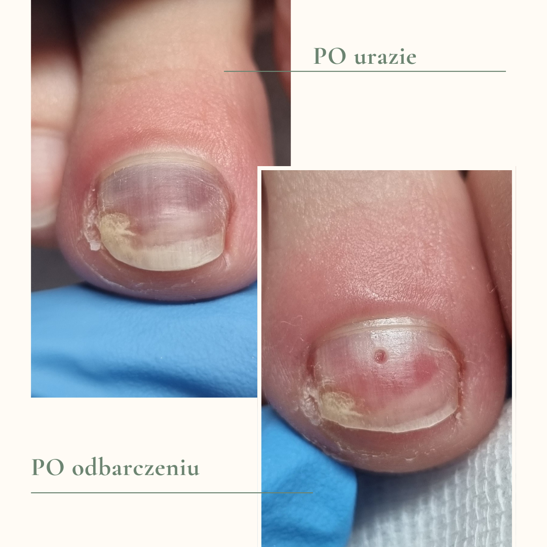 paznokieć z krwiakiem